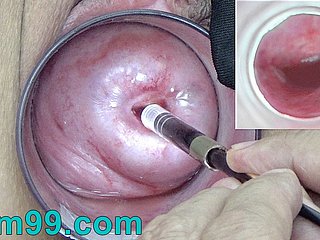 Japanese Endoscope Camera inside Cervix Cam come into possession of Vagina
